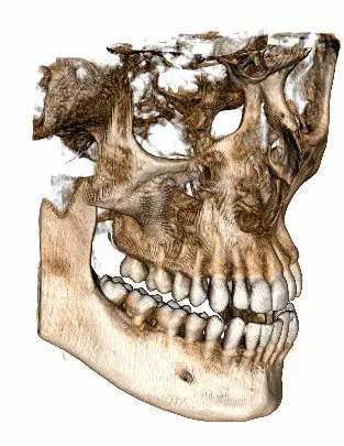 La radiologia Odontoiatrica 3D. La evoluzione nella implantologia.